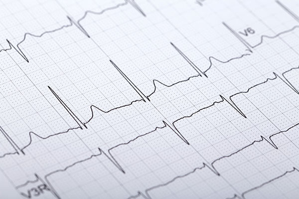 检查不规则脉波检测作为血压计选法那个其他的便利的功能，起作用